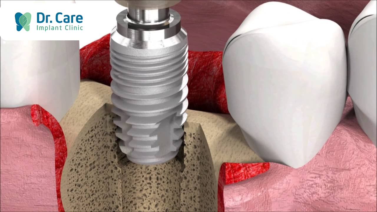 Trụ Implant Sic Tìm Hiểu Xuất Xứ ưu điểm Và Giá Cả Dr Care